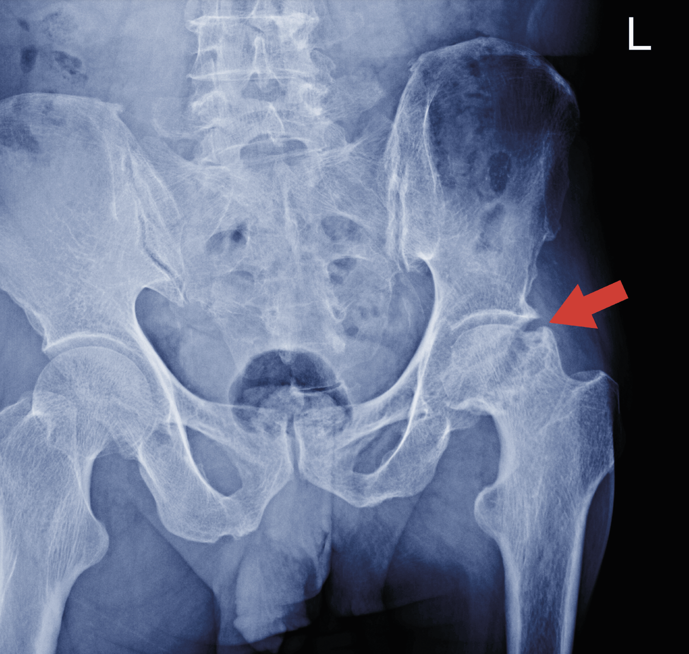 Veranstaltung Arztvortrag Osteoporose